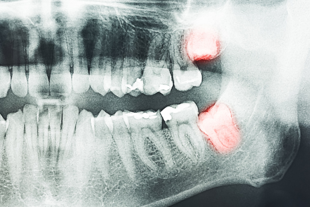 An xray of the mouth
