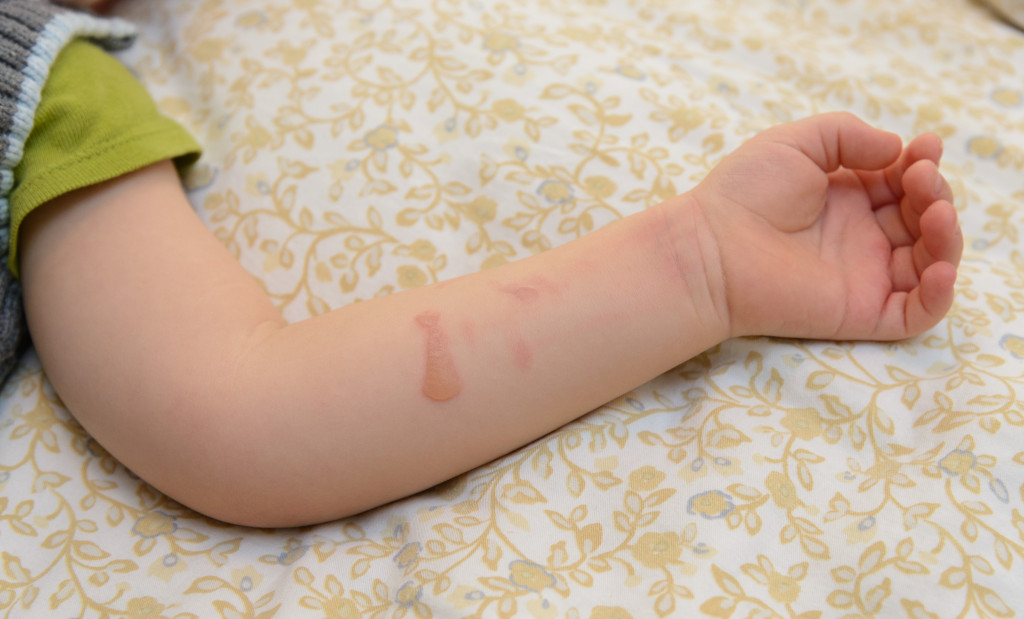 A child's arm with a burn mark